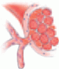 Acute leukemia with a very high leukocyte count: Confronting a medical emergency