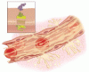 Recognizing and managing hereditary angioedema
