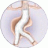 Endovascular therapy or conventional vascular surgery? A complex choice