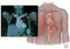 Incidentally detected noninfectious thoracic aortitis: A clinical approach
