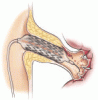 Stenting atherosclerotic renal arteries: Time to be less aggressive