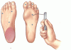 A practical guide for examining and treating the diabetic foot
