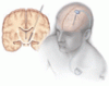 Deep brain stimulation: What can patients expect from it?