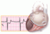 ST-segment depression and T-wave inversion: Classification, differential diagnosis, and caveats