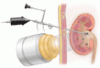 Less-invasive ways to remove stones from the kidneys and ureters