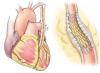 The FREEDOM trial: In appropriate patients with diabetes and multivessel coronary artery disease, CABG beats PCI
