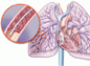 Do patients with submassive pulmonary embolism benefit from thrombolytic therapy?