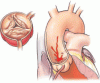 Options for managing severe aortic stenosis: A case-based review