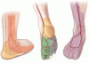 Acute and critical limb ischemia: When time is limb