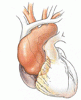 CT imaging for acute aortic syndrome