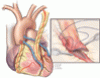 Coronary artery bypass grafting: Practice trends and projections