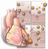 Familial hypercholesterolemia: Detect, treat, and ask about family
