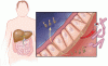Alcoholic hepatitis: Challenges in diagnosis and management