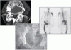 Paget disease of bone: Diagnosis and drug therapy