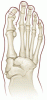 Charcot neuroarthropathy: An often overlooked complication of diabetes