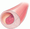 New insights into ischemic heart disease in women