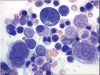 Myelodysplastic syndromes: A practical approach to diagnosis and treatment