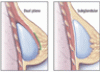 Breast augmentation surgery: Clinical considerations