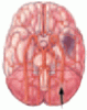 Preventing ischemic stroke: Choosing the best strategy