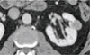 Small renal masses: Toward more rational treatment