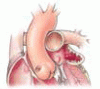 Left atrial appendage closure: An emerging option in atrial fibrillation when oral anticoagulants are not tolerated