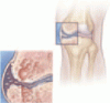Managing knee osteoarthritis before and after arthroplasty