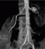 Recognizing and managing fibromuscular dysplasia