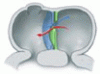 When and how to fix a ‘hole in the heart’: Approach to ASD and PFO