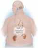 The role of GLP-1 receptor agonists in managing type 2 diabetes