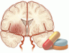 Antiplatelet therapy to prevent recurrent stroke: Three good options