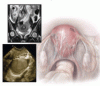 Role of imaging in endometriosis