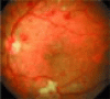 The internist’s role in managing diabetic retinopathy: Screening for early detection