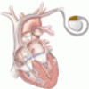 Pacing in heart failure: The benefit of resynchronization