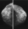 How should we screen for breast cancer? Mammography, ultrasonography, MRI