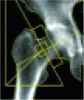 DXA scanning to diagnose osteoporosis: Do you know what the results mean?
